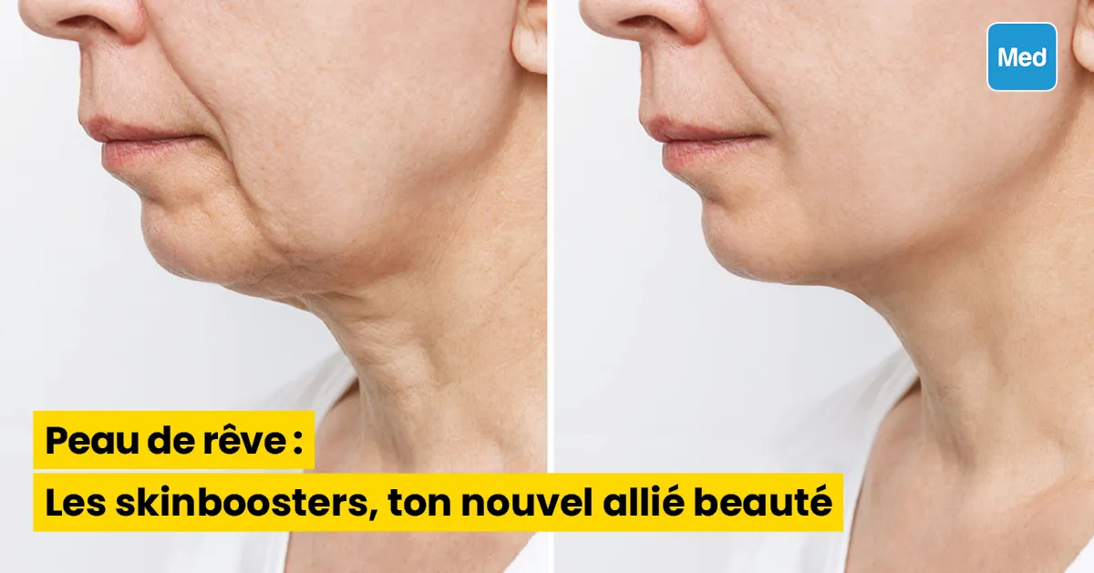 Peau de rêve : Les skinboosters, ton nouvel allié beauté